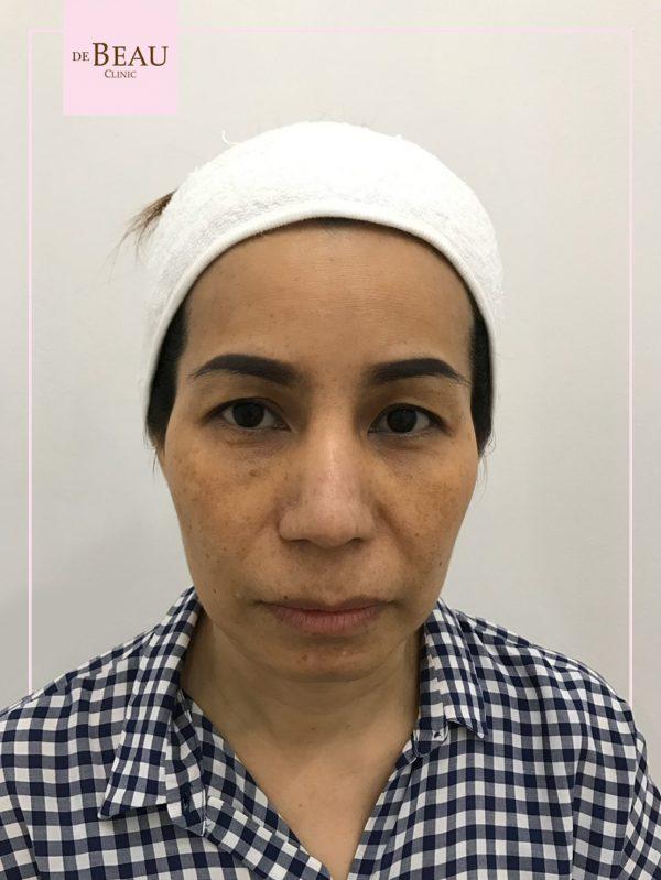 รีวิว ขมับตอบ ฟิลเลอร์ขมับ