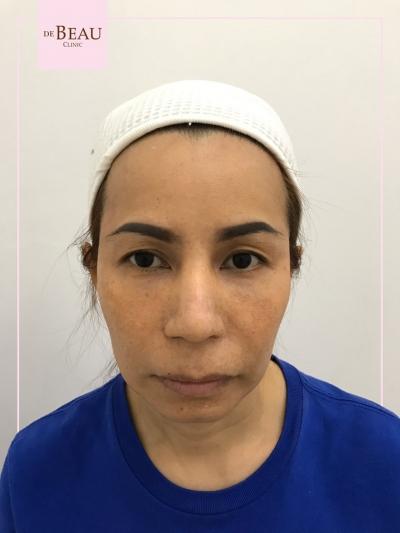 รีวิว ขมับตอบ ฟิลเลอร์ขมับ