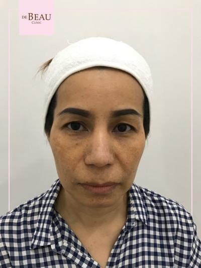 รีวิว ขมับตอบ ฟิลเลอร์ขมับ