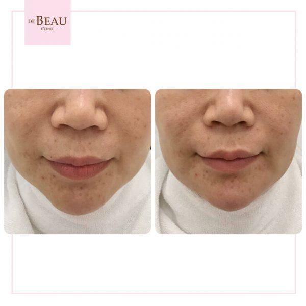 รีวิวคาง ปรับรูปหน้า ปรับโครงสร้างหน้า เสริมคาง