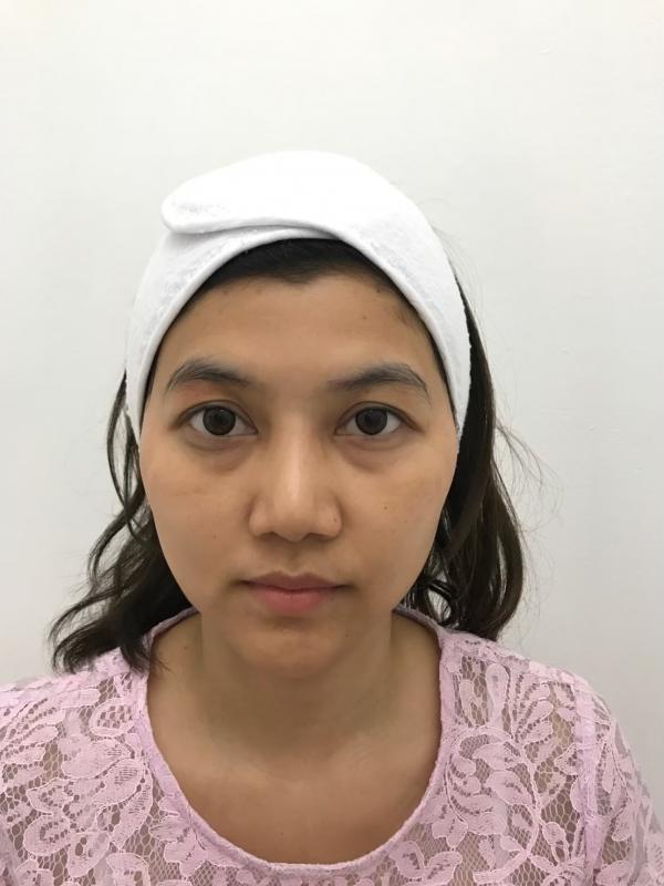 ขมับตอบ ฟิลเลอร์แก้มตอบ