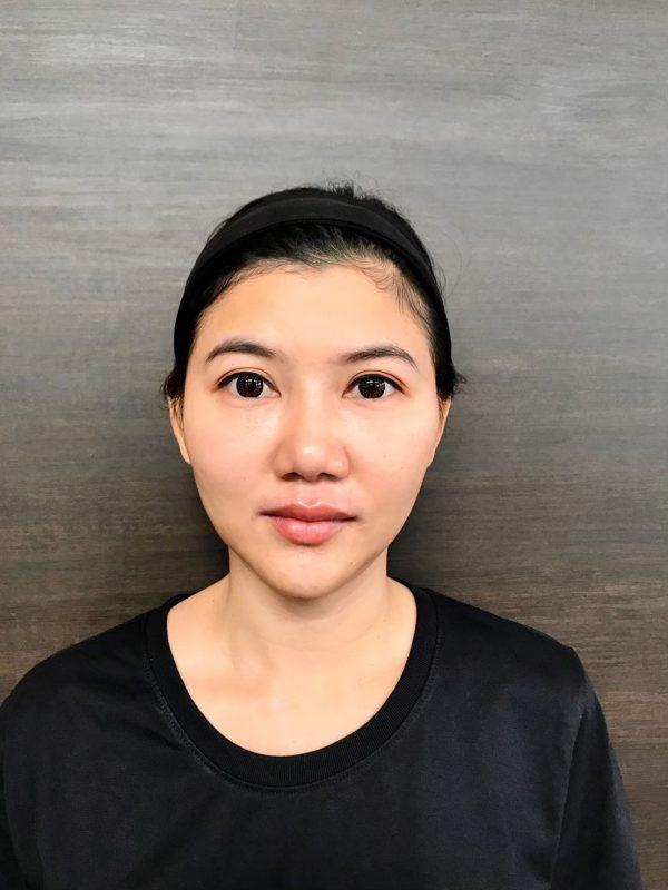 ขมับตอบ ฟิลเลอร์แก้มตอบ