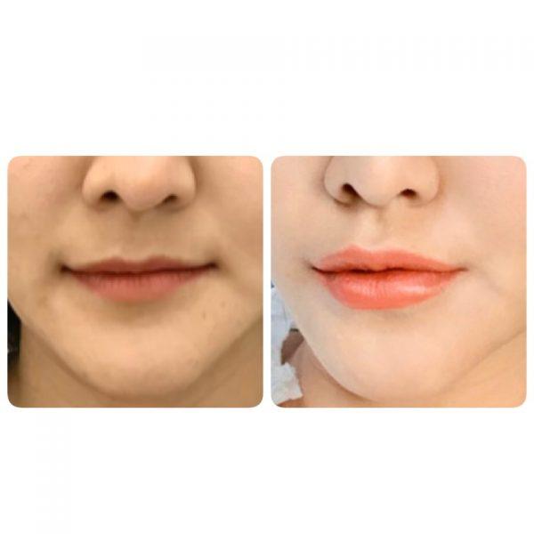 ฟิลเลอร์ปาก ฉีดปาก แก้ทรงปาก ฉีดฟิลเลอร์ปาก ฟิลเลออร์ริมฝีปาก