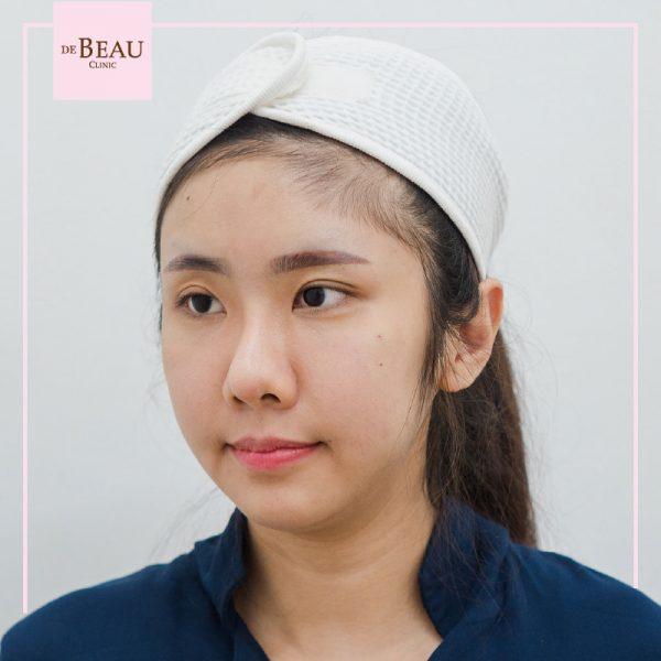 ฟิลเลอร์ ฉีดฟิลเลอร์ ซิลิโคนเหลว ซิลิโคน ฟิลเลอร์ใต้ตา รอยตาคล้ำ รอยหมองดำ