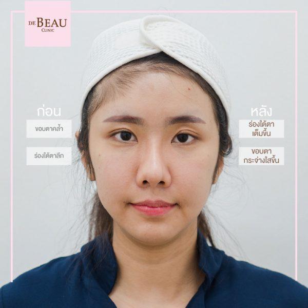 ฟิลเลอร์ ฉีดฟิลเลอร์ ซิลิโคนเหลว ซิลิโคน ฟิลเลอร์ใต้ตา รอยตาคล้ำ รอยหมองดำ