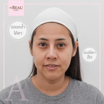 ฟิลเลอร์ ฉีดฟิลเลอร์ ซิลิโคนเหลว ซิลิโคน ฟิลเลอร์ใต้ตา รอยตาคล้ำ รอยหมองดำ