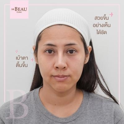 ฟิลเลอร์ ฉีดฟิลเลอร์ ซิลิโคนเหลว ซิลิโคน ฟิลเลอร์ใต้ตา รอยตาคล้ำ รอยหมองดำ
