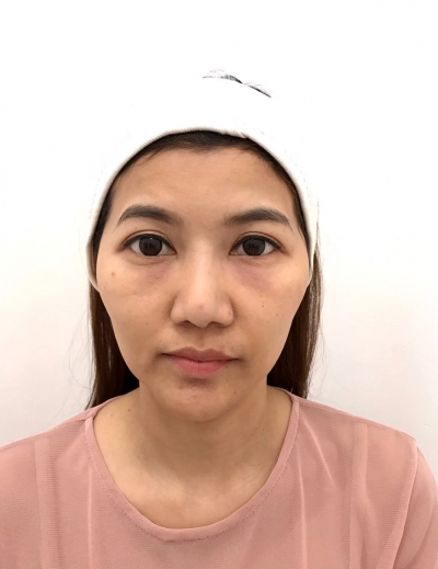 ขมับตอบ ฟิลเลอร์แก้มตอบ