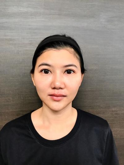 ขมับตอบ ฟิลเลอร์แก้มตอบ