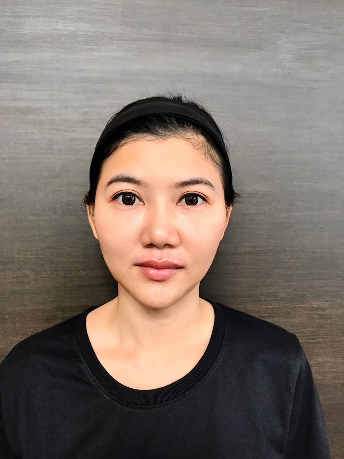 ขมับตอบ ฟิลเลอร์แก้มตอบ