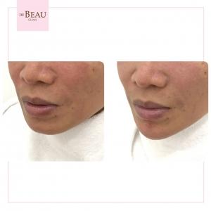 รีวิวคาง ปรับรูปหน้า ปรับโครงสร้างหน้า เสริมคาง ฟิลเลอร์คาง