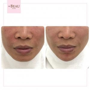 รีวิวคาง ปรับรูปหน้า ปรับโครงสร้างหน้า เสริมคาง ฟิลเลอร์คาง