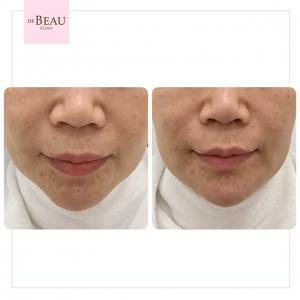 รีวิวคาง ฟิลเลอร์คาง ปรับรูปหน้า ปรับโครงสร้างหน้า เสริมคาง