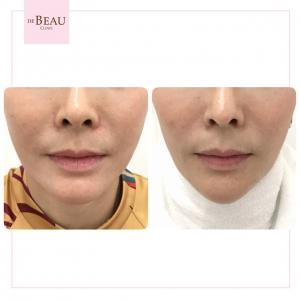 รีวิวคาง ปรับรูปหน้า ปรับโครงสร้างหน้า เสริมคาง