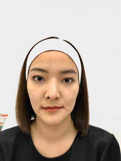 ฟิลเลอร์ปาก ฉีดปาก แก้ทรงปาก ฉีดฟิลเลอร์ปาก ฟิลเลออร์ริมฝีปาก