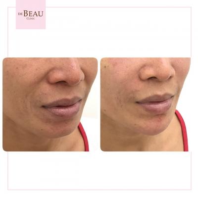 ฟิลเลอร์ร่องแก้ม รีวิว ร่องแก้ม ฟิลเลอร์แก้ม แก้มตอบ ร่องแก้ม 