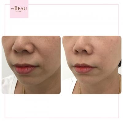 ฟิลเลอร์ร่องแก้ม รีวิว ร่องแก้ม ฟิลเลอร์แก้ม แก้มตอบ ร่องแก้ม 