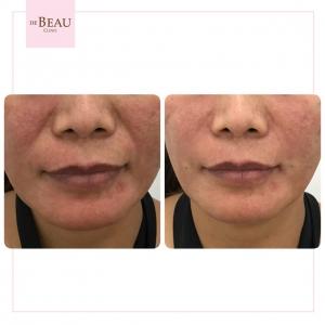 รีวิว ร่องแก้ม ฟิลเลอร์แก้ม แก้มตอบ ร่องแก้ม