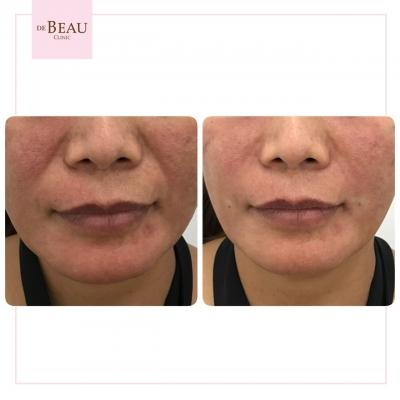 ฟิลเลอร์ร่องแก้ม รีวิว ร่องแก้ม ฟิลเลอร์แก้ม แก้มตอบ ร่องแก้ม 