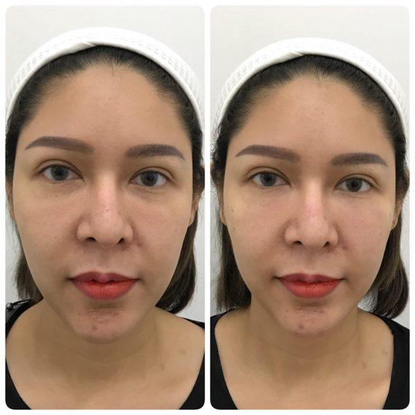 Review ฟิลเลอร์ใต้ตา คุณมายด์ BY DE BEAU CLINIC