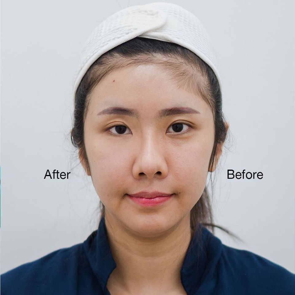 Review ฟิลเลอร์ใต้ตา คุณโซ BY DE BEAU CLINIC