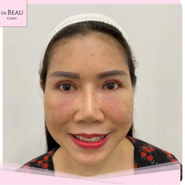 Review ฟิลเลอร์ใต้ตา คุณหน่อย BY DE BEAU CLINIC