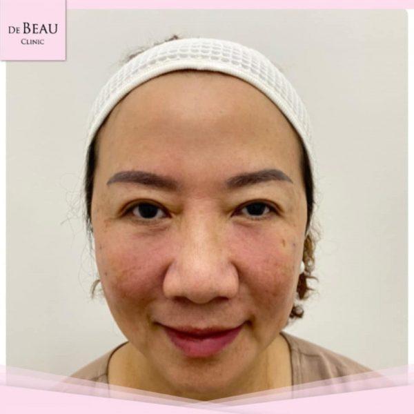 Review ฟิลเลอร์ใต้ตา คุณอ้อ BY DE BEAU CLINIC
