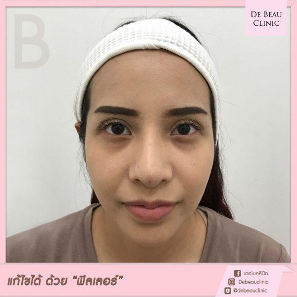 Review ฟิลเลอร์ใต้ตา คุณจี BY DE BEAU CLINIC