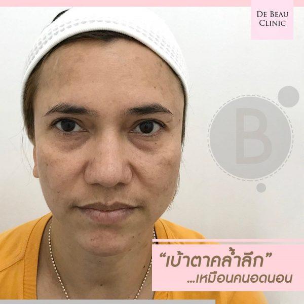 Review ฟิลเลอร์ใต้ตา คุณหน่อง BY DE BEAU CLINIC