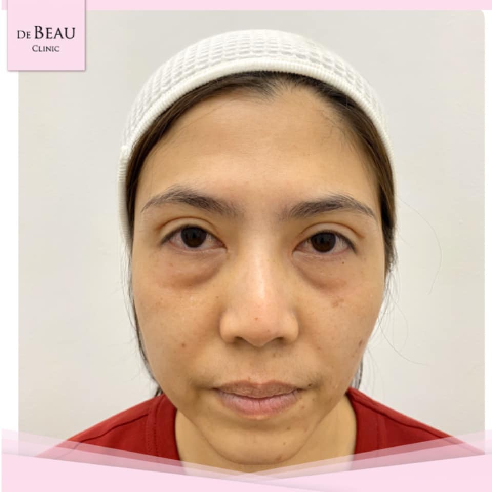 Review ฟิลเลอร์ใต้ตา คุณโจ้ BY DE BEAU CLINIC