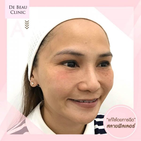 Review ฟิลเลอร์ใต้ตา คุณเอ BY DE BEAU CLINIC