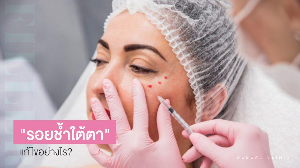 รอยช้ำใต้ตา ฉีดฟิลเลอร์แล้วมีรอยช้ำ แก้ไขอย่างไร?
