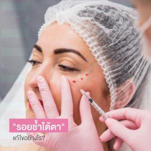 รอยช้ำใต้ตา ฉีดฟิลเลอร์แล้วมีรอยช้ำ แก้ไขอย่างไร?