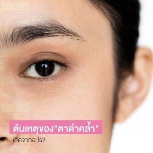 รอบตาคล้ำ ใต้ตาคล้ำมาก ต้นเหตุของขอบตาดำคล้ำ ไม่สดใส เกิดจากอะไร?
