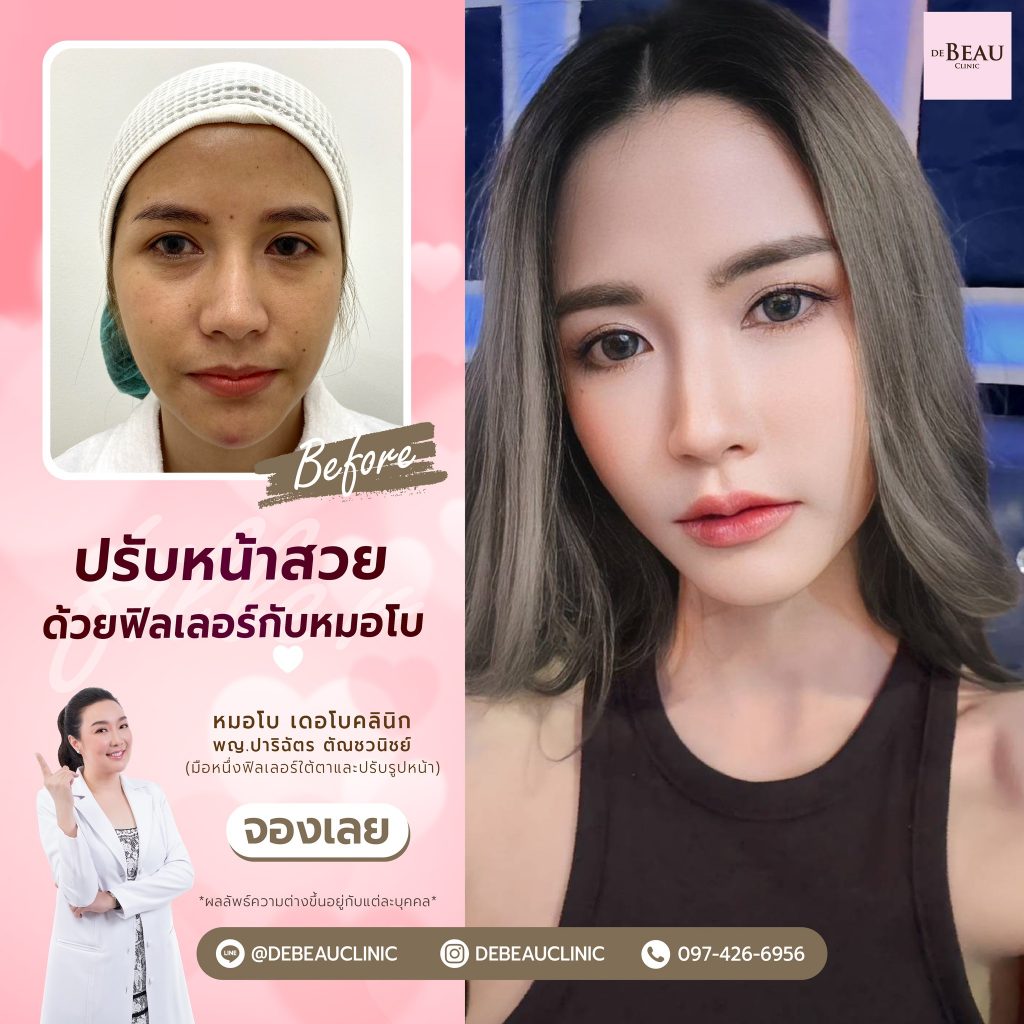 ฉีดฟิลเลอร์แก้ปัญหาใต้ตา