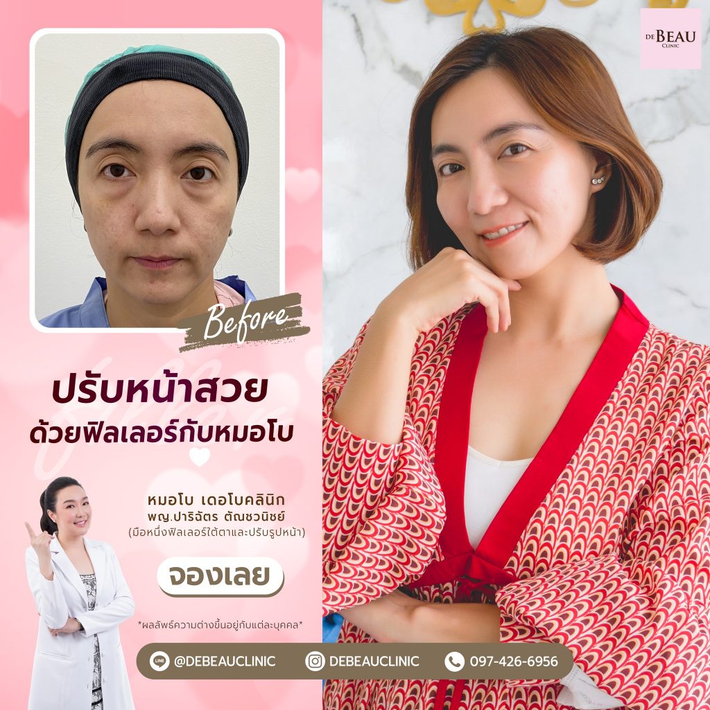 ฉีดฟิลเลอร์แก้ปัญหาใต้ตา