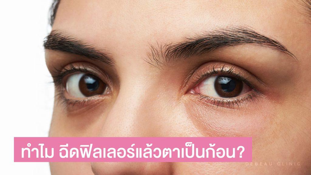 ฉีดฟิลเลอร์แล้วตาเป็นก้อน