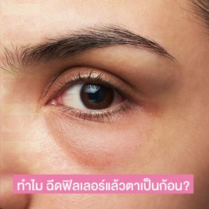 ฉีดฟิลเลอร์แล้วตาเป็นก้อน