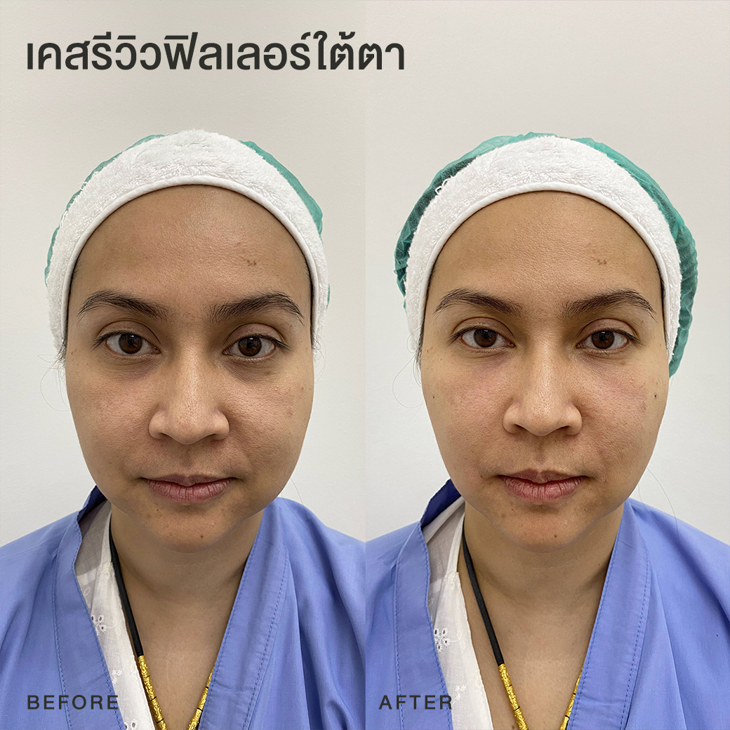 รีวิวฟิลเลอร์ใต้ตา หมอโบ