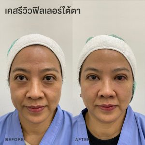 รีวิวฟิลเลอร์ใต้ตา หมอโบ