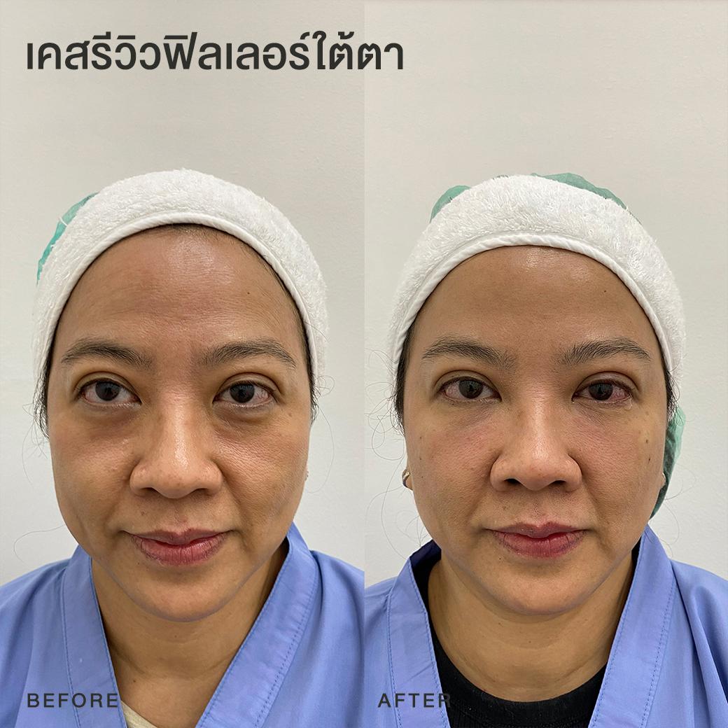 รีวิวฟิลเลอร์ใต้ตา หมอโบ