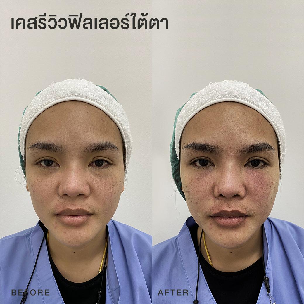 รีวิวฟิลเลอร์ใต้ตา หมอโบ