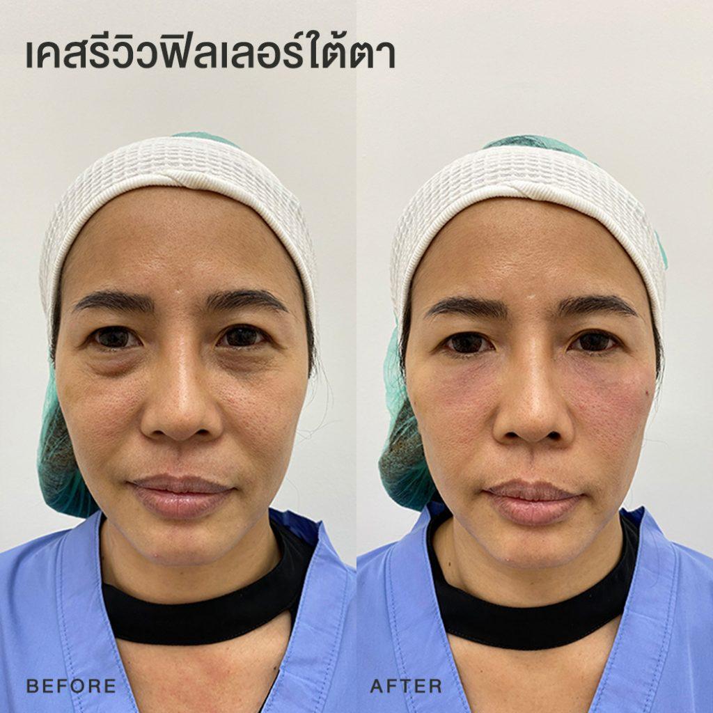 รีวิวฟิลเลอร์ใต้ตา หมอโบ