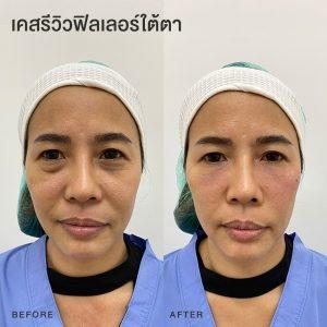 รีวิวฟิลเลอร์ใต้ตา หมอโบ