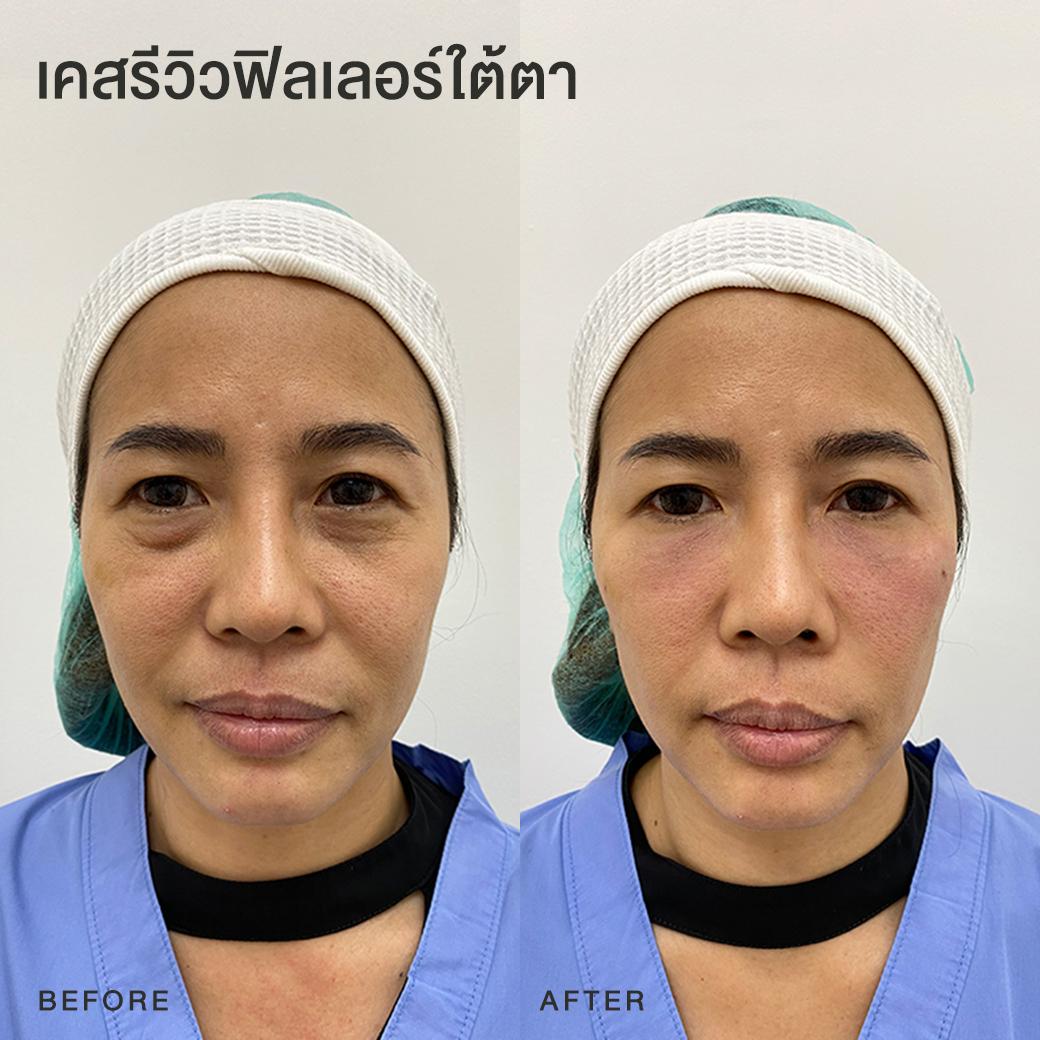 รีวิวฟิลเลอร์ใต้ตา หมอโบ