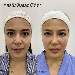 รีวิวฟิลเลอร์ใต้ตา หมอโบ