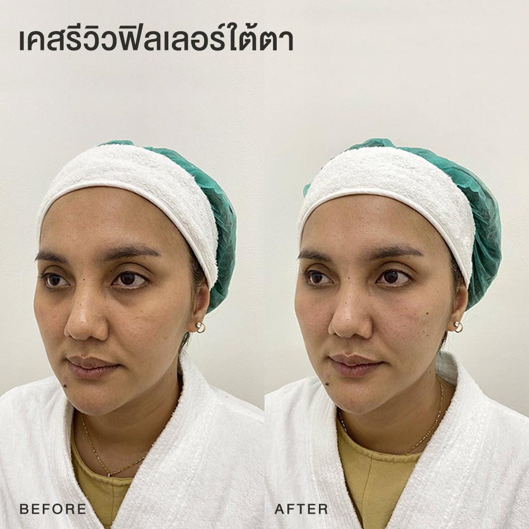 รีวิวฟิลเลอร์ใต้ตา หมอโบ