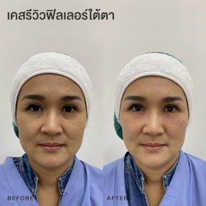 รีวิวฟิลเลอร์ใต้ตา หมอโบ