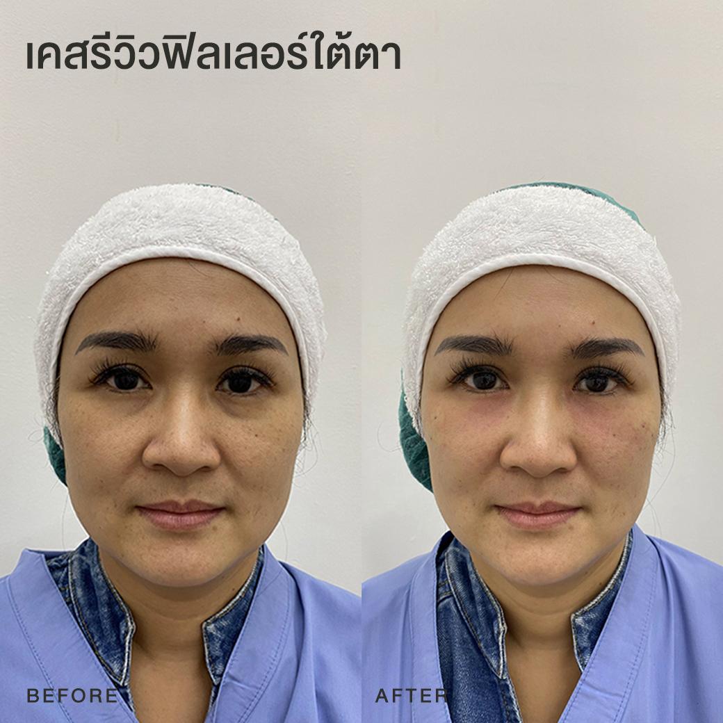 รีวิวฟิลเลอร์ใต้ตา หมอโบ