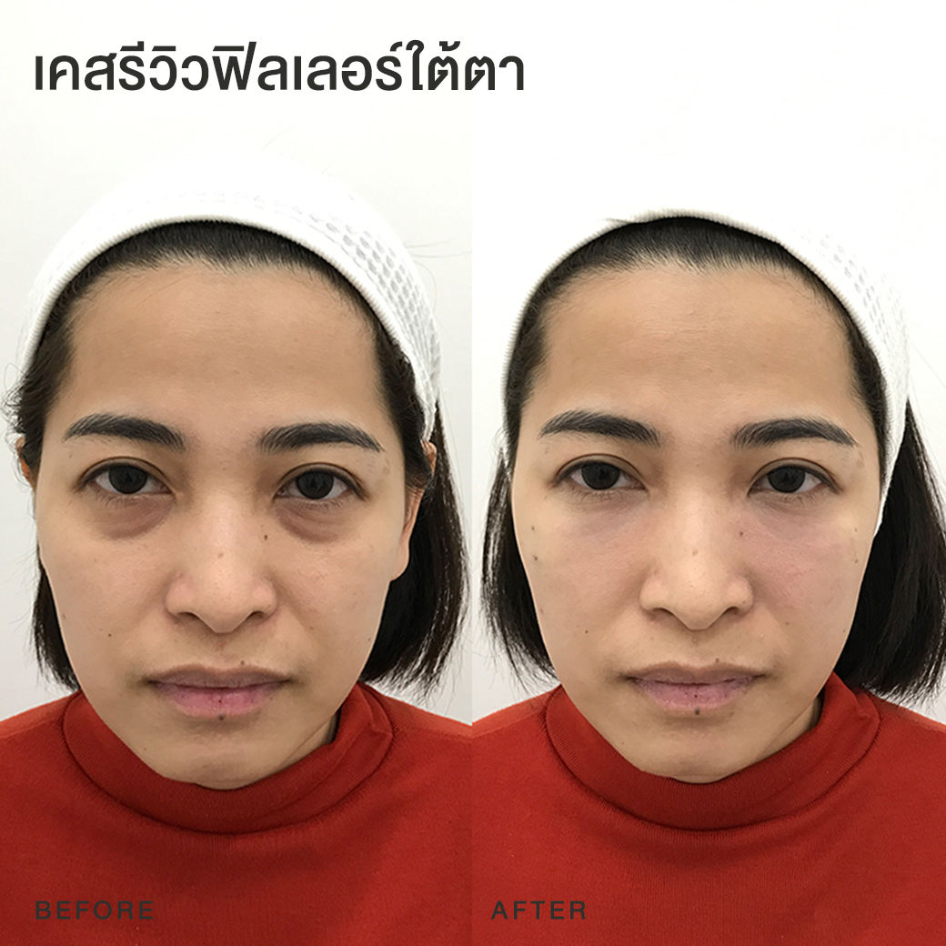 รีวิวฟิลเลอร์ใต้ตา หมอโบ